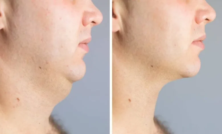 Neck Lift in Dubai